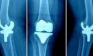 Curso Internacional de Artroplastia Primaria Compleja de Rodilla